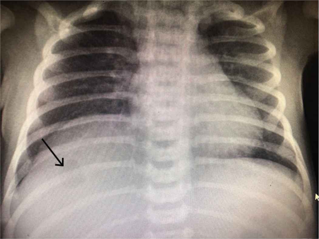 Liver Abscess In A Term Baby A Case Report And Review Of Literature Atlantis Press Liver Abscess In A Term Baby A Case Report And Review Of Literature Atlantis Press