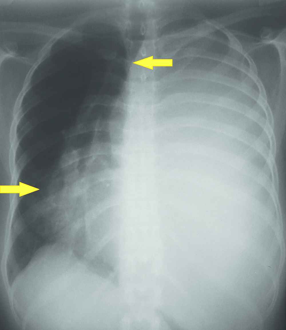 mesothelioma civil case